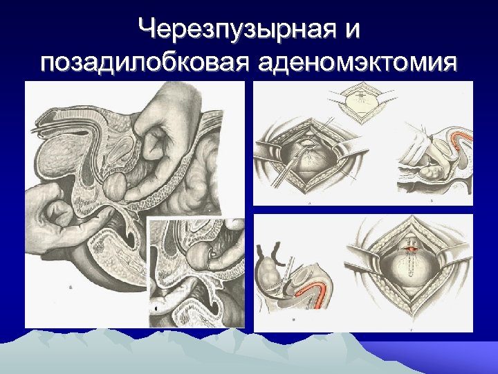 Черезпузырная и позадилобковая аденомэктомия 