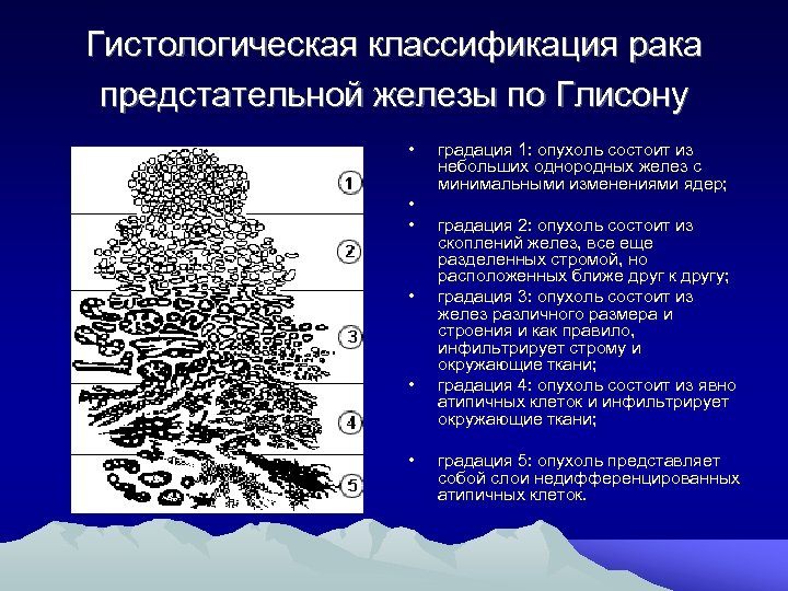 Гистологическая классификация рака предстательной железы по Глисону • • • градация 1: опухоль состоит