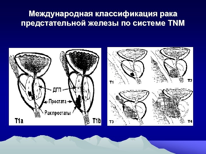 Международная классификация рака предстательной железы по системе TNM 