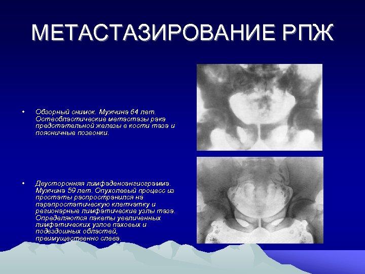 МЕТАСТАЗИРОВАНИЕ РПЖ • Обзорный снимок. Мужчина 64 лет. Остеобластические метастазы рака предстательной железы в