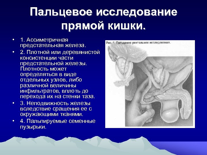 Пальцевое исследование прямой кишки. • 1. Ассиметричная предстательная железа. • 2. Плотной или деревянистой