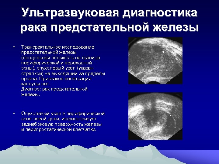 Ультразвуковая диагностика рака предстательной железы • Трансректальное исследование предстательной железы (продольная плоскость на границе