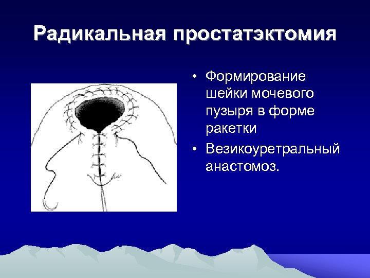 Радикальная простатэктомия • Формирование шейки мочевого пузыря в форме ракетки • Везикоуретральный анастомоз. 