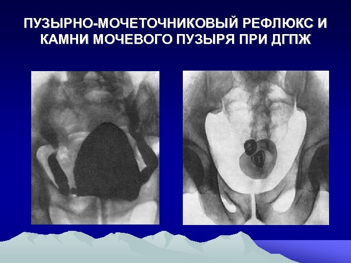 ПУЗЫРНО-МОЧЕТОЧНИКОВЫЙ РЕФЛЮКС И КАМНИ МОЧЕВОГО ПУЗЫРЯ ПРИ ДГПЖ 