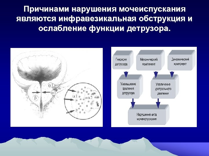 Причинами нарушения мочеиспускания являются инфравезикальная обструкция и ослабление функции детрузора. 