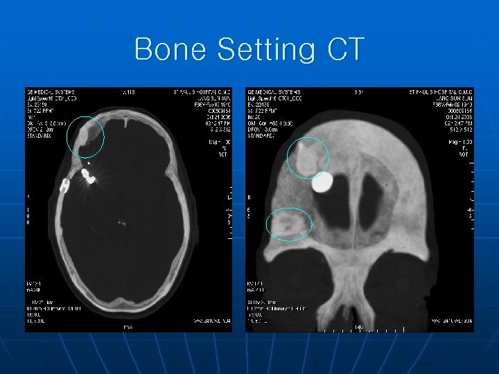 Bone Setting CT 