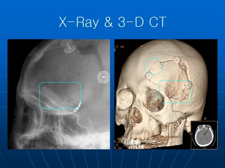 X-Ray & 3 -D CT 