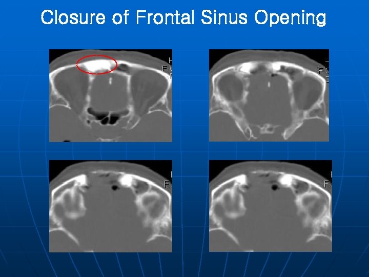 Closure of Frontal Sinus Opening 