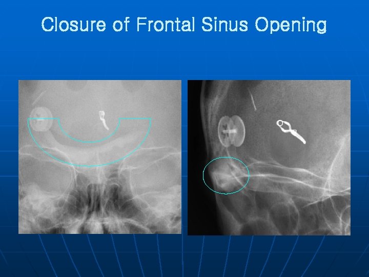 Closure of Frontal Sinus Opening 