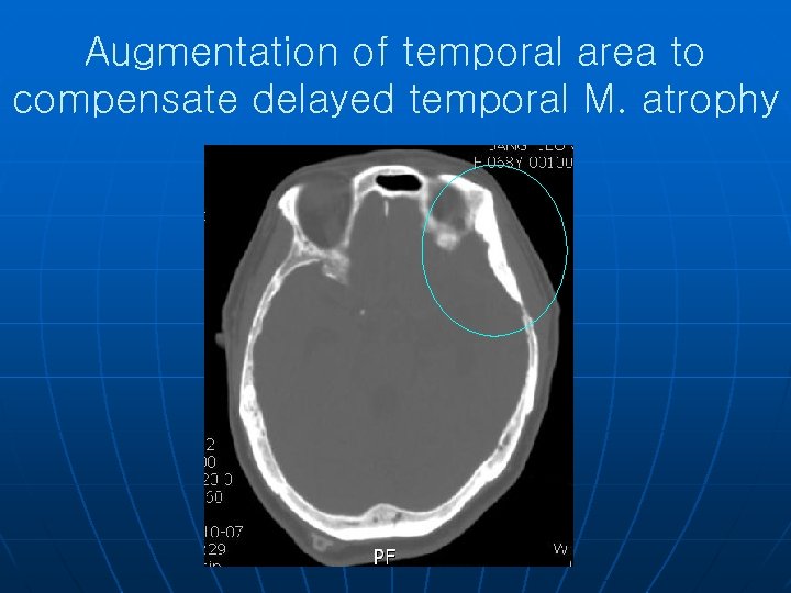 Augmentation of temporal area to compensate delayed temporal M. atrophy 