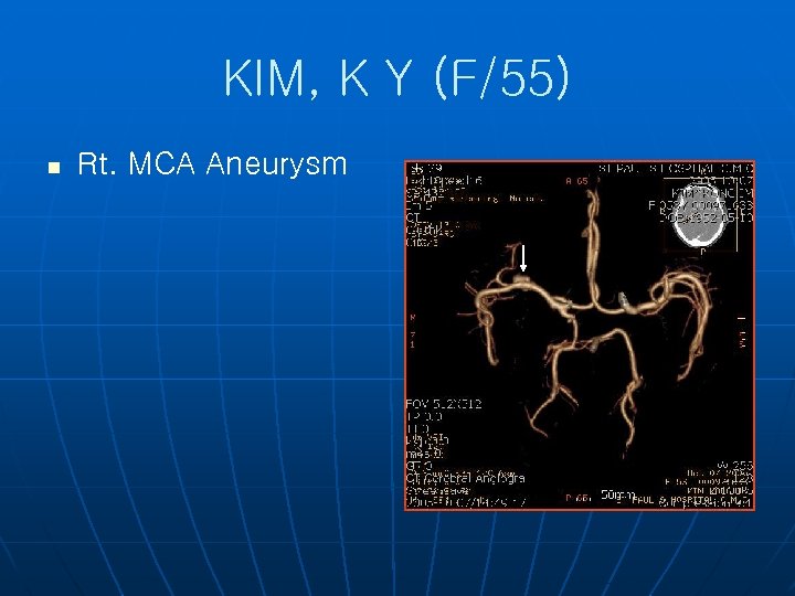 KIM, K Y (F/55) n Rt. MCA Aneurysm 