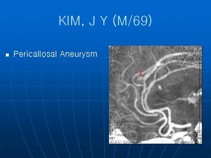 KIM, J Y (M/69) n Pericallosal Aneurysm 