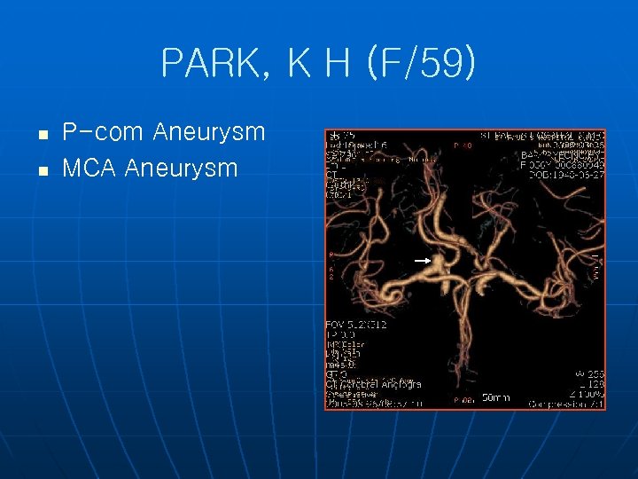 PARK, K H (F/59) n n P-com Aneurysm MCA Aneurysm 