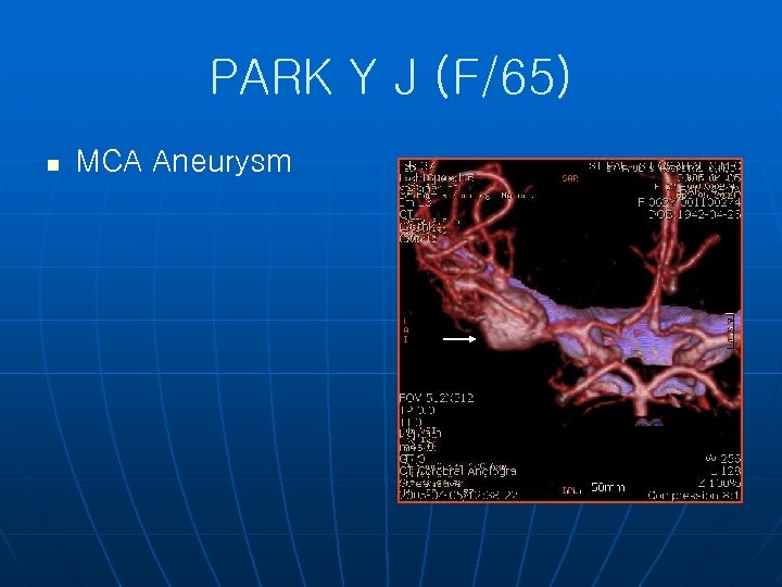 PARK Y J (F/65) n MCA Aneurysm 