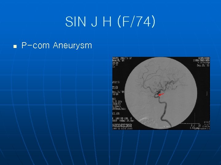 SIN J H (F/74) n P-com Aneurysm 