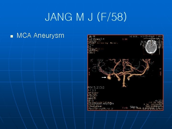 JANG M J (F/58) n MCA Aneurysm 