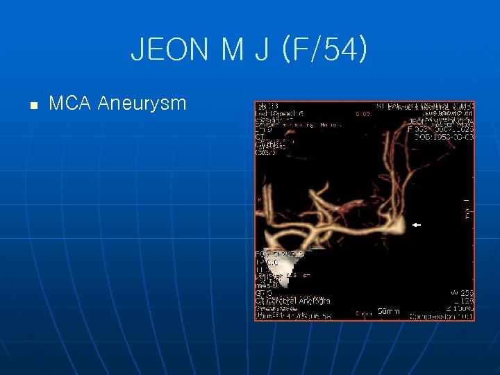 JEON M J (F/54) n MCA Aneurysm 