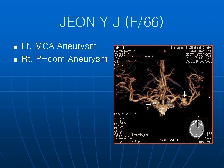 JEON Y J (F/66) n n Lt. MCA Aneurysm Rt. P-com Aneurysm 