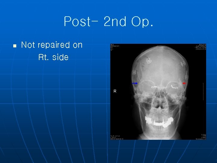 Post- 2 nd Op. n Not repaired on Rt. side 