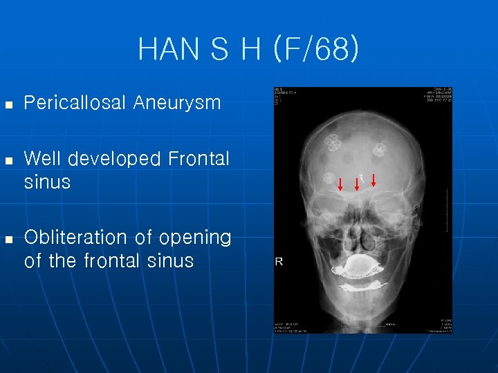 HAN S H (F/68) n Pericallosal Aneurysm n Well developed Frontal sinus n Obliteration