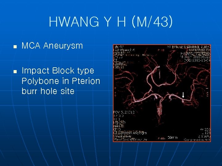 HWANG Y H (M/43) n MCA Aneurysm n Impact Block type Polybone in Pterion