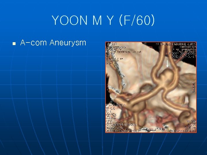 YOON M Y (F/60) n A-com Aneurysm 