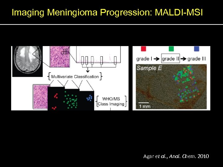 Imaging Meningioma Progression: MALDI-MSI Agar et al. , Anal. Chem. 2010 