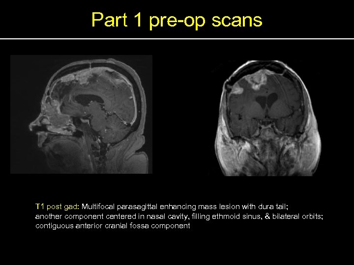 Part 1 pre-op scans T 1 post gad: Multifocal parasagittal enhancing mass lesion with