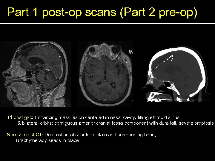 Part 1 post-op scans (Part 2 pre-op) T 1 post gad: Enhancing mass lesion