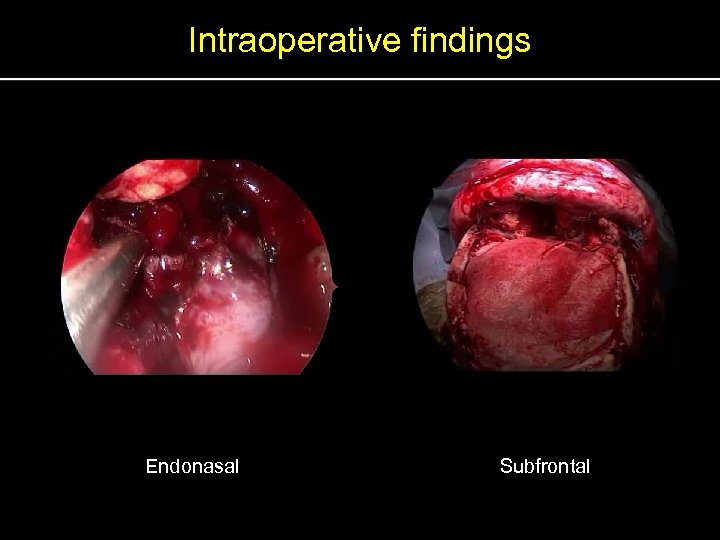 Intraoperative findings Endonasal Subfrontal 