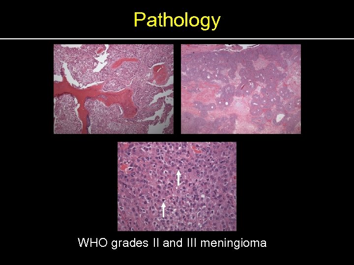 Pathology WHO grades II and III meningioma 