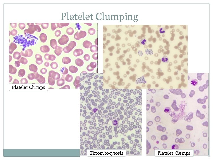 Platelet Clumping Platelet Clumps Thrombocytosis Platelet Clumps 