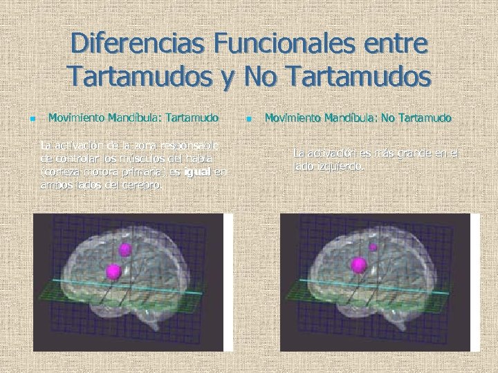 Diferencias Funcionales entre Tartamudos y No Tartamudos n Movimiento Mandíbula: Tartamudo La activación de