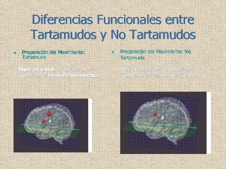 Diferencias Funcionales entre Tartamudos y No Tartamudos n Preparación del Movimiento: Tartamudo Hiperactividad en