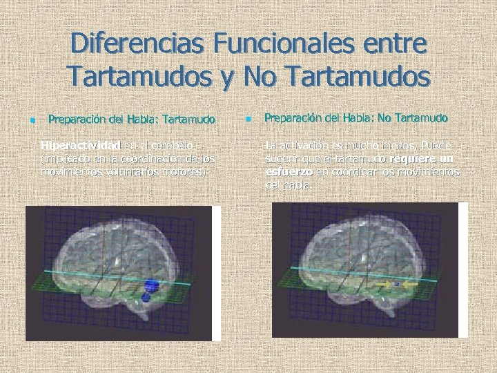 Diferencias Funcionales entre Tartamudos y No Tartamudos n Preparación del Habla: Tartamudo Hiperactividad en