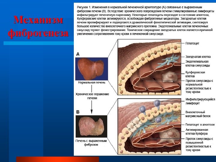 Механизм фиброгенеза 