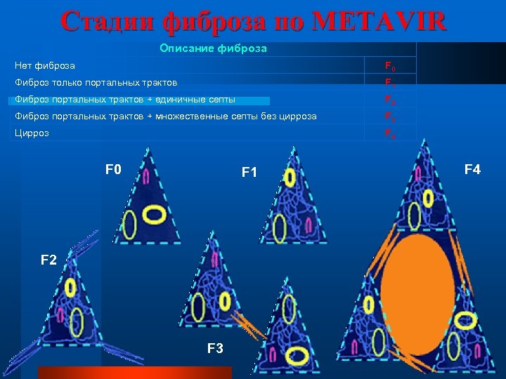 Стадии фиброза по METAVIR Описание фиброза Нет фиброза F 0 Фиброз только портальных трактов