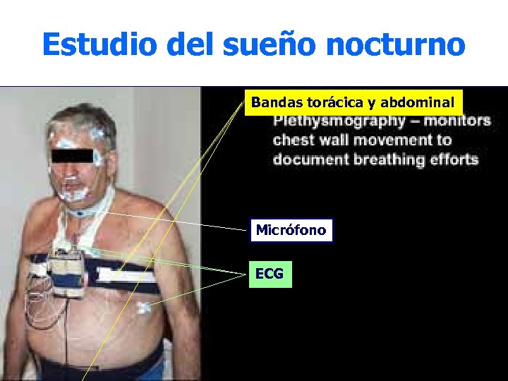 Estudio del sueño nocturno Bandas torácica y abdominal Micrófono ECG 