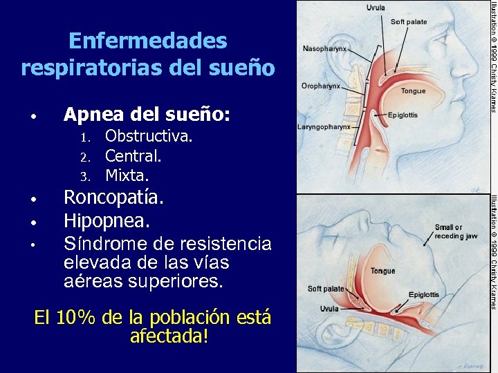 Enfermedades respiratorias del sueño • Apnea del sueño: 1. 2. 3. • • •