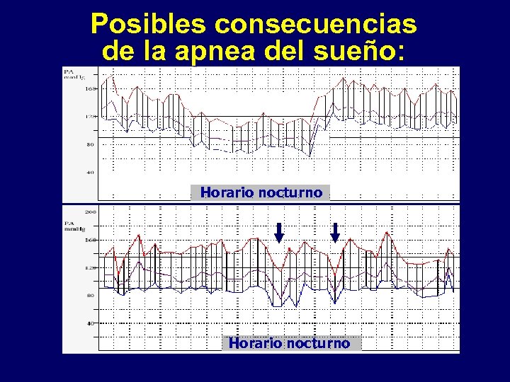 Posibles consecuencias de la apnea del sueño: Horario nocturno 