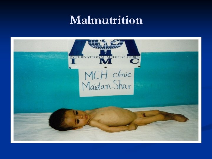 Malmutrition 