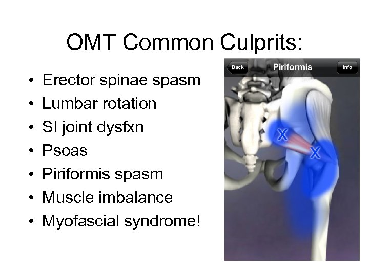 OMT Common Culprits: • • Erector spinae spasm Lumbar rotation SI joint dysfxn Psoas