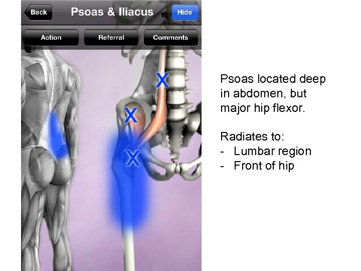 Psoas located deep in abdomen, but major hip flexor. Radiates to: - Lumbar region