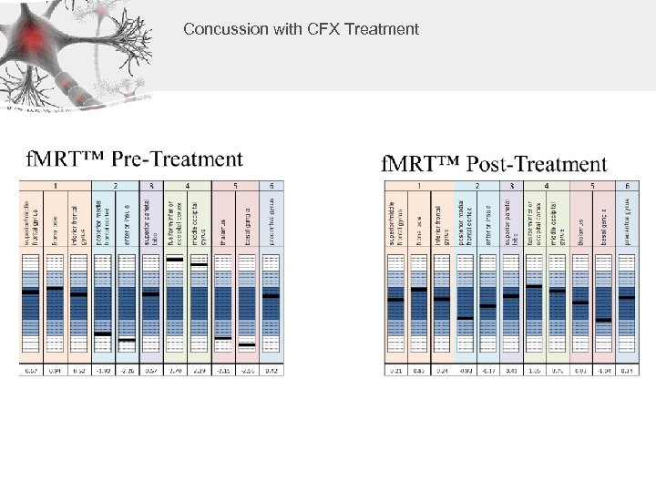 Concussion with CFX Treatment 