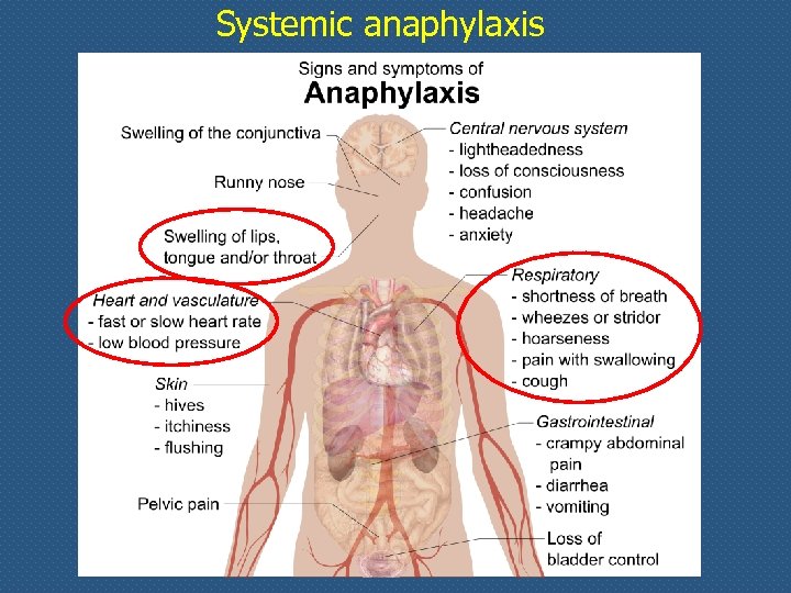 Systemic anaphylaxis 