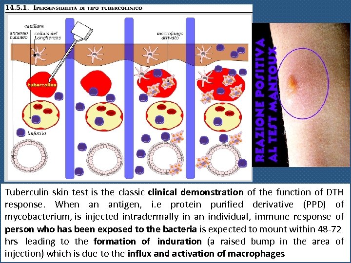 Tuberculin skin test is the classic clinical demonstration of the function of DTH response.