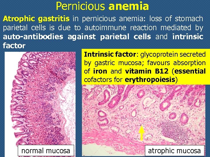 Pernicious anemia Atrophic gastritis in pernicious anemia: loss of stomach parietal cells is due