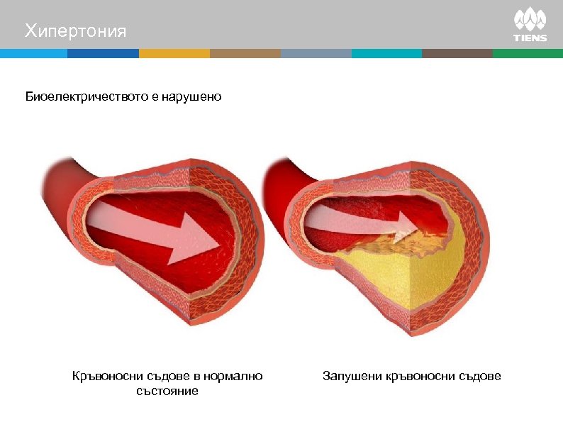 Хипертония Биоелектричеството е нарушено Кръвоносни съдове в нормално състояние Запушени кръвоносни съдове 