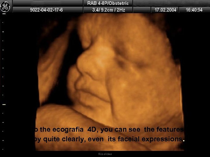 Thanks to the ecografia 4 D, you can see the features of the baby