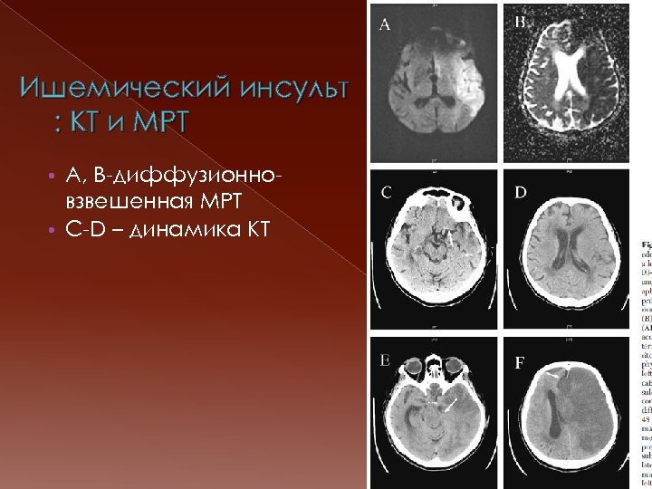 Ишемический инсульт : КТ и МРТ • А, B-диффузионновзвешенная МРТ • C-D – динамика